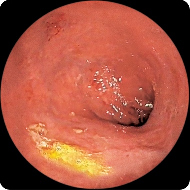Patient 1’s rectum at week 12 on RINVOQ showing little to no visible evidence of active Crohn's (endoscopic remission)