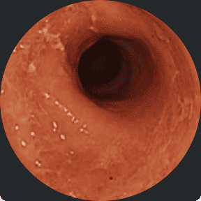Endoscopy image of a colon before starting RINVOQ