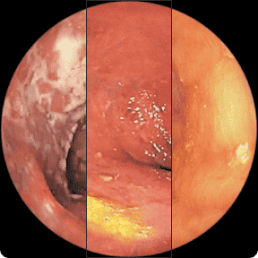 Endoscopy images from a clinical trial patient taken before starting RINVOQ, after 12 weeks of treatment, and after 1 year of treatment