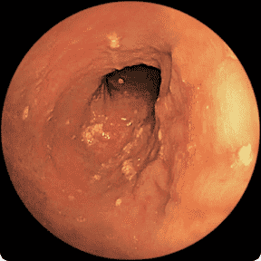 Endoscopy image of a colon after taking RINVOQ for 1 year
