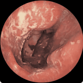 Endoscopy image of a colon before starting RINVOQ