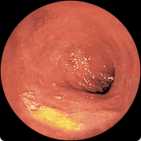 Endoscopy image of a colon after taking RINVOQ for 12 weeks