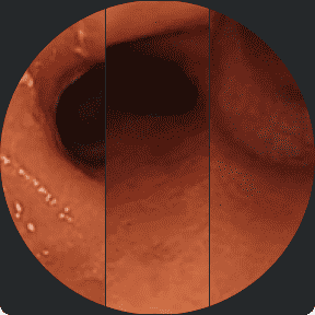 Endoscopy images from a clinical trial patient taken before starting RINVOQ, after 8 weeks of treatment, and after 1 year of treatment.