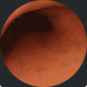 Endoscopy image of a colon after taking RINVOQ for 8 weeks