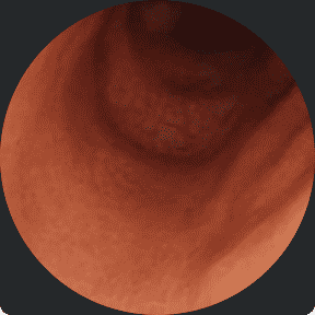 Endoscopy image of a colon after taking RINVOQ for 1 year