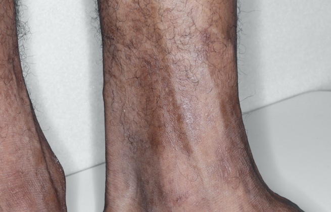 Adult ankle after RINVOQ treatment