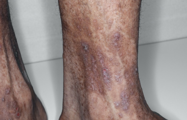 Adult ankle with eczema before RINVOQ treatment