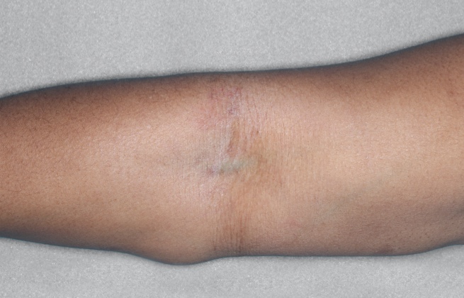 Adult arm after RINVOQ treatment