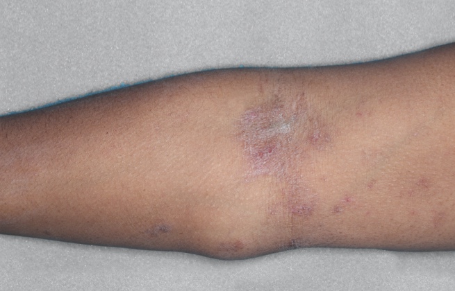 Adult arm with eczema before RINVOQ treatment