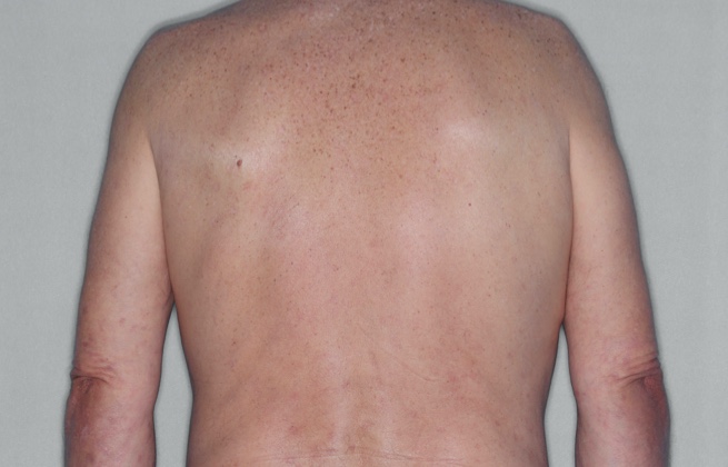 Adult after RINVOQ treatment