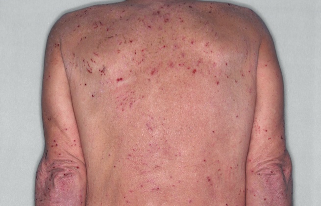Adult back with eczema before RINVOQ treatment