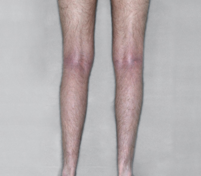 Adult leg after RINVOQ treatment