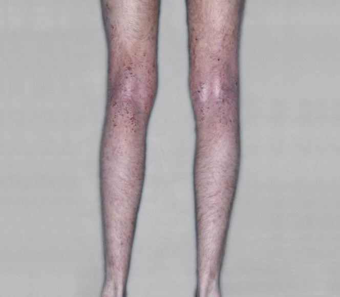 Adult legs with eczema before RINVOQ treatment