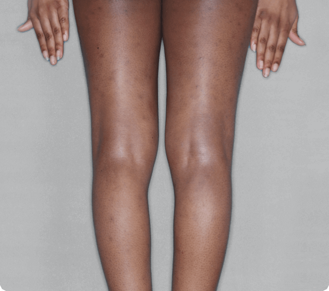 Legs after RINVOQ treatment