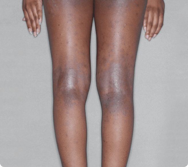 Legs with eczema before RINVOQ treatment