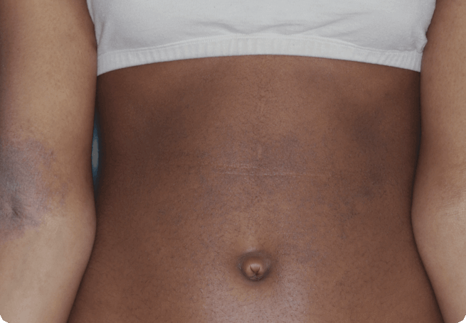 Torso, after RINVOQ treatment