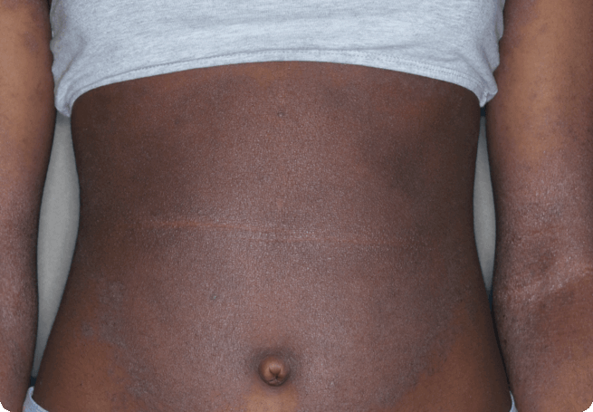 Torso with eczema before RINVOQ treatment