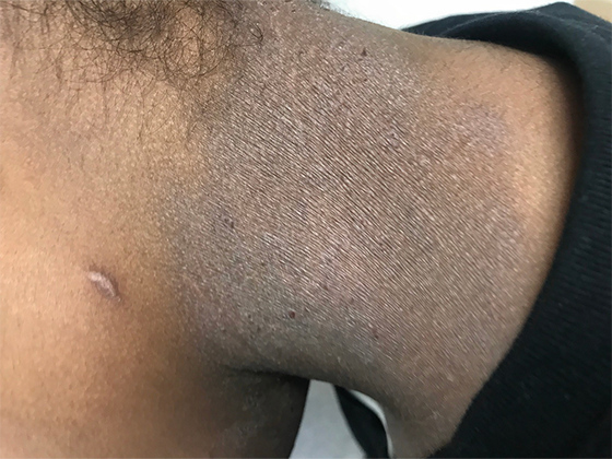 Image of neck with eczema on black skin