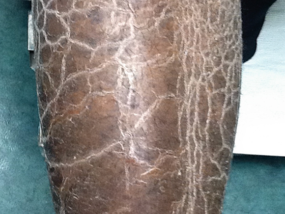 Image of eczema on skin of a darker color