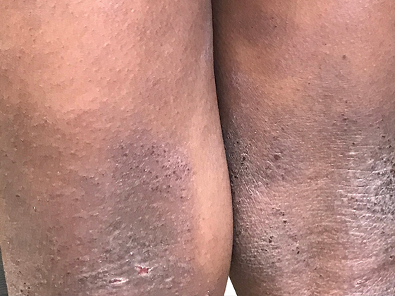 Image of knees with eczema on black skin
