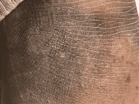 Image of eczema on black skin