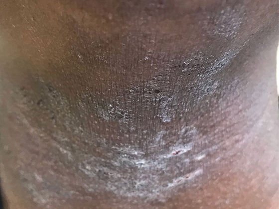 Image of eczema rash