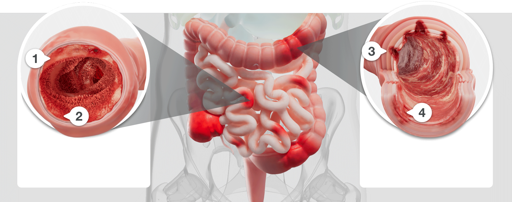 Illustration showing damage to the intestinal lining caused by inflammation