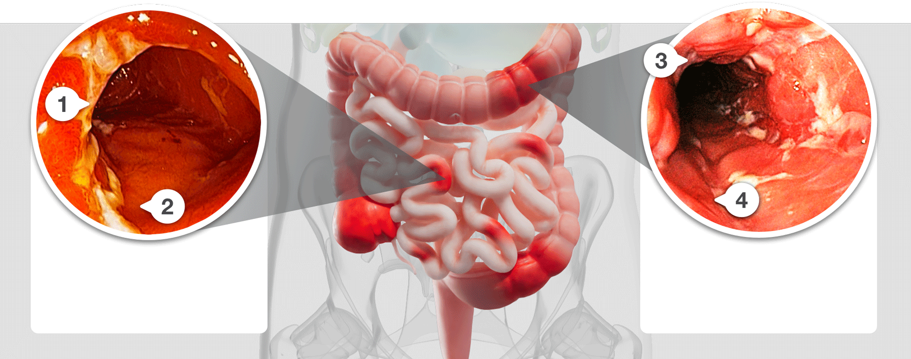 Endoscopy image showing damage to the intestinal lining caused by inflammation