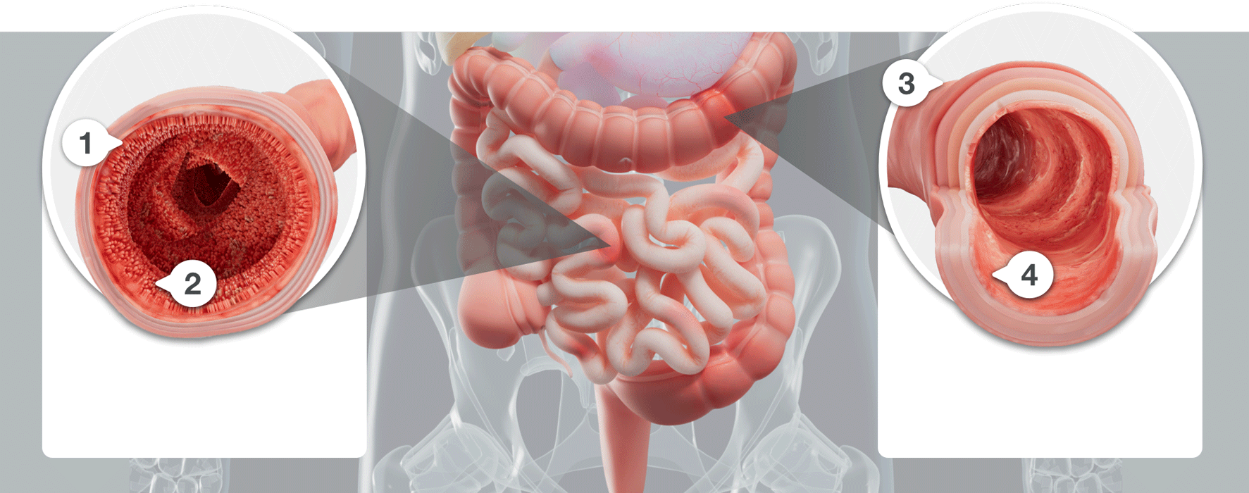 Illustration showing visible repair of the intestinal lining