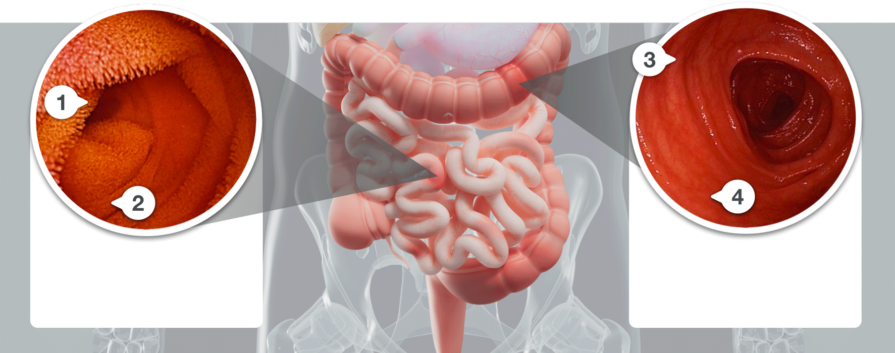Endoscopy image showing visible repair of the intestinal lining