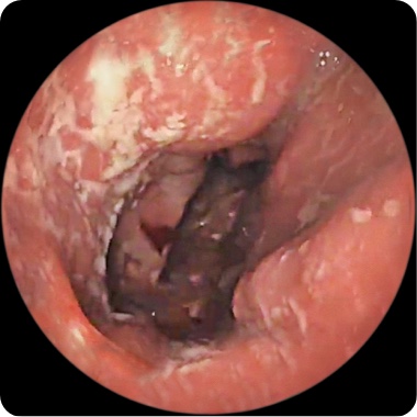 Patient 1’s rectum before taking RINVOQ showing visible intestinal lining damage