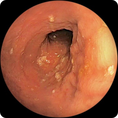 Patient 1’s rectum after 1 year on RINVOQ showing little to no visible evidence of active Crohn's (endoscopic remission)