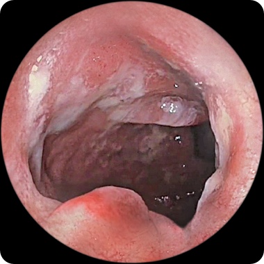 Patient 2’s rectum before taking RINVOQ showing visible intestinal lining damage