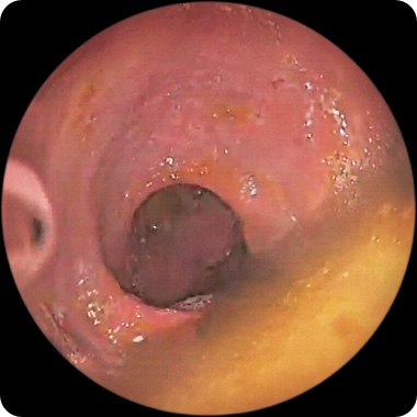 Patient 2’s rectum at week 12 on RINVOQ