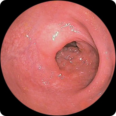 Patient 2’s rectum after 1 year on RINVOQ showing visibly reduced intestinal lining damage (endoscopic response)