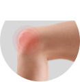 Psoriatic Arthritis Knee