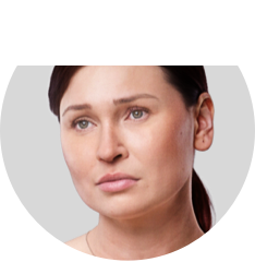 Psoriatic arthritis fatigue