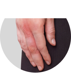 psoriatic arthritis hands