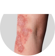 Skin plaque