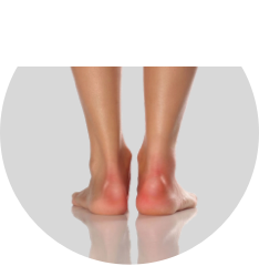 Psoriatic arthritis Achilles tendon