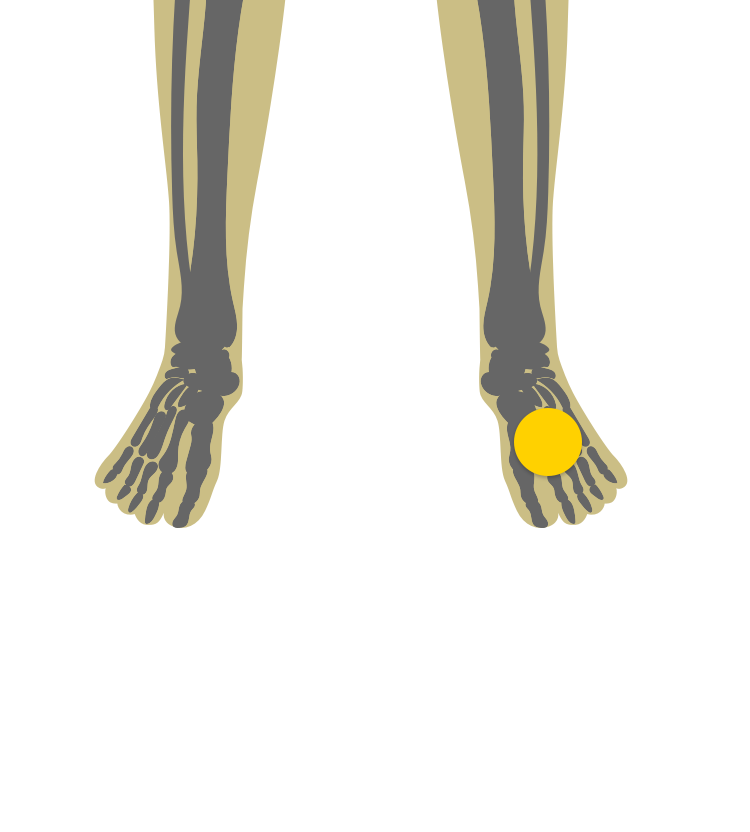 Illustration of legs indicating inflamed tendons or ligaments where attached to bone