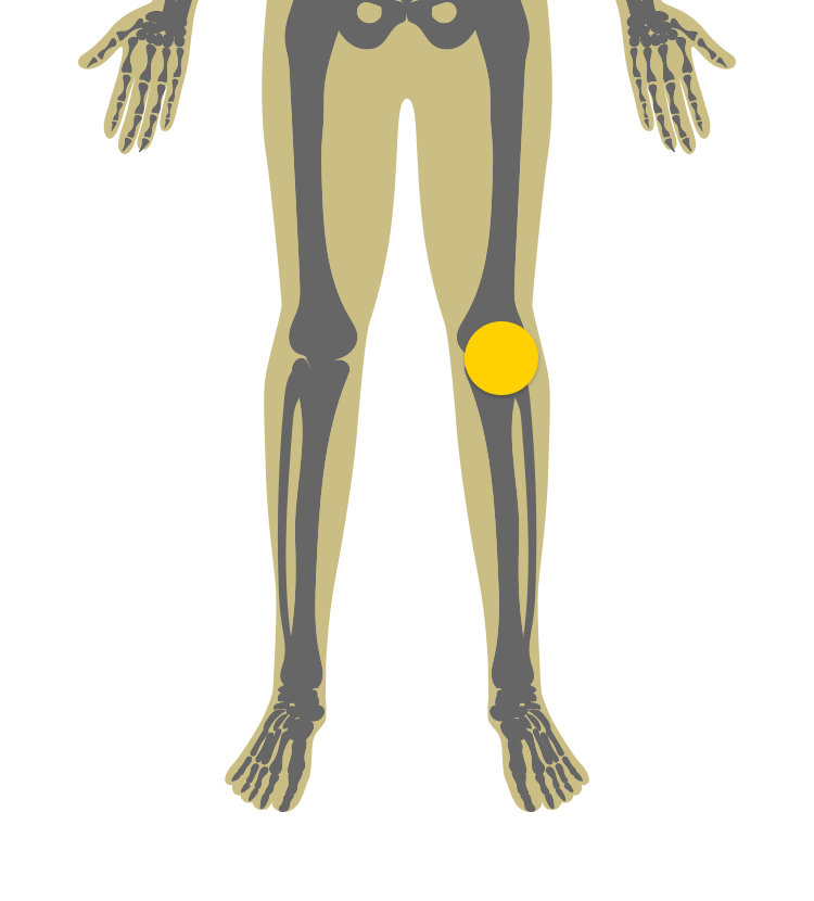 Illustration of lower body indicating irreversible joint damage