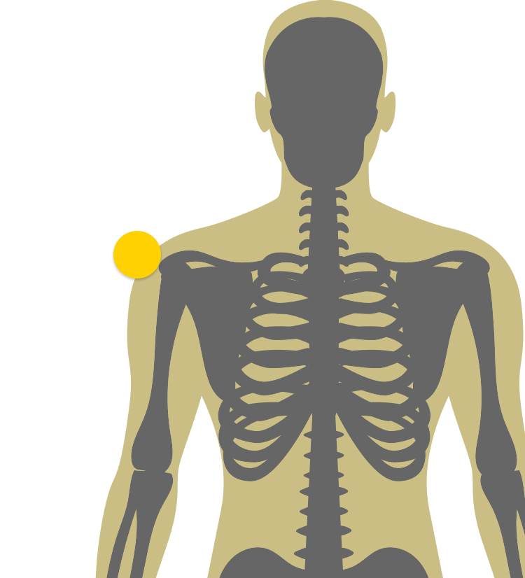 Illustration of side of body indicating joint pain and swelling