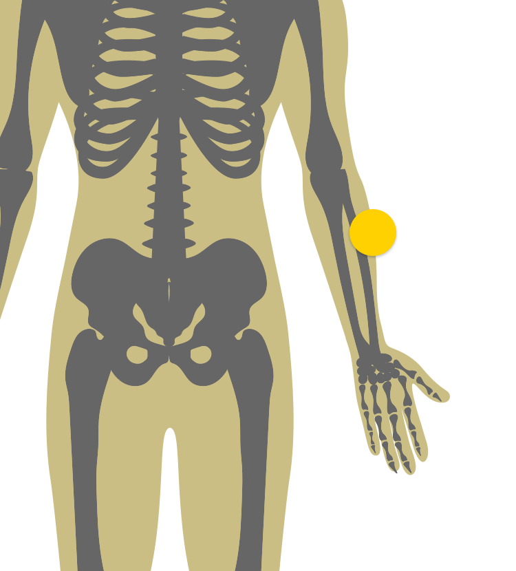 Illustration of body indicating psa skin plaques