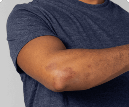 Illustration of PsA skin plaques on an elbow after treatment