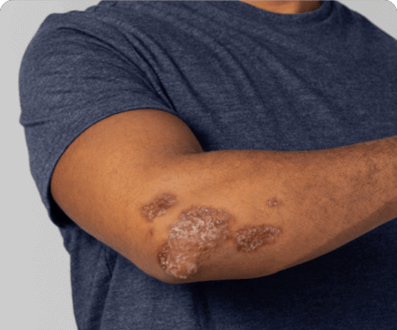 Illustration of PsA skin plaques on an elbow before treatment