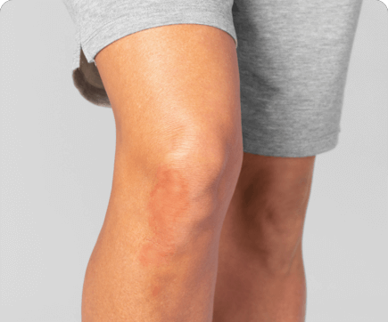Illustration of PsA skin plaques on a knee after treatment