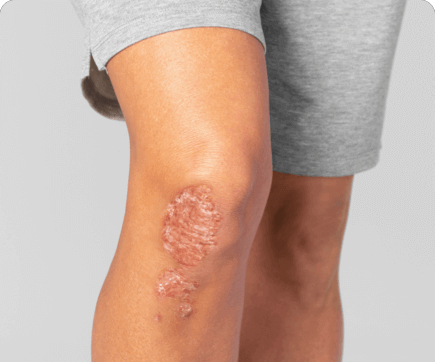 Illustration of PsA skin plaques on a knee before treatment
