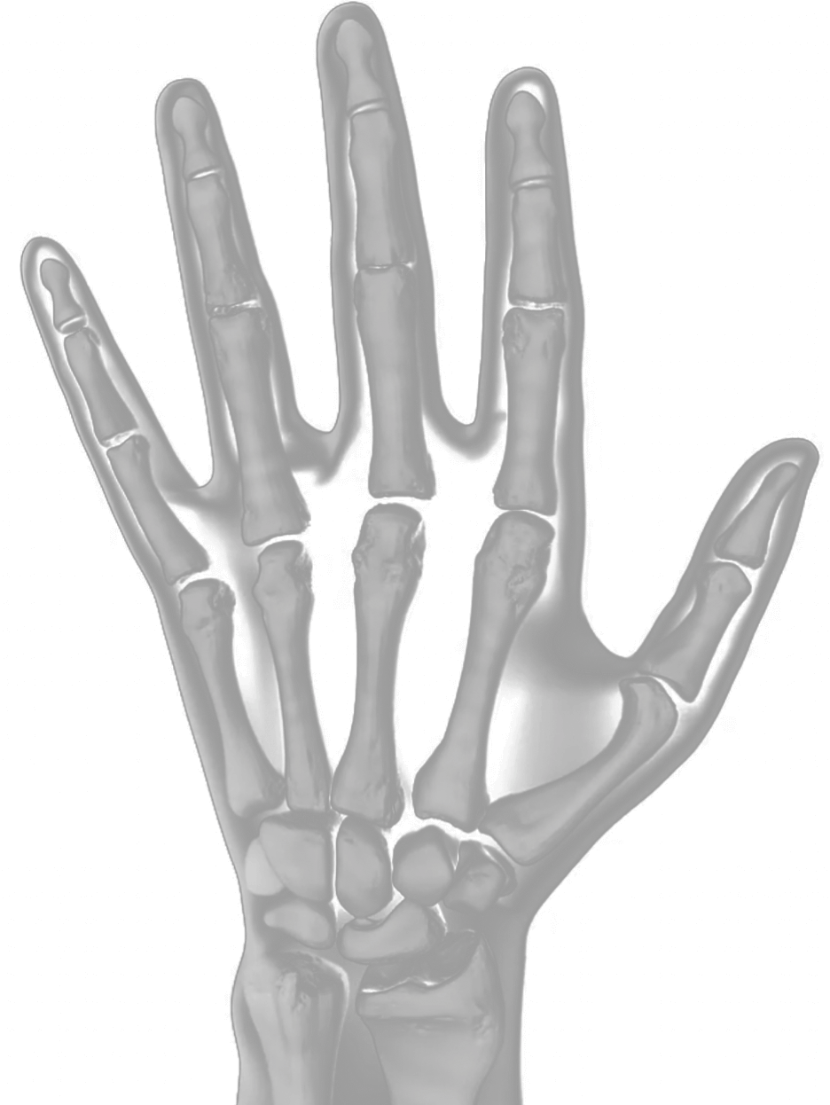 X-ray of a hand showing worsening RA joint damage