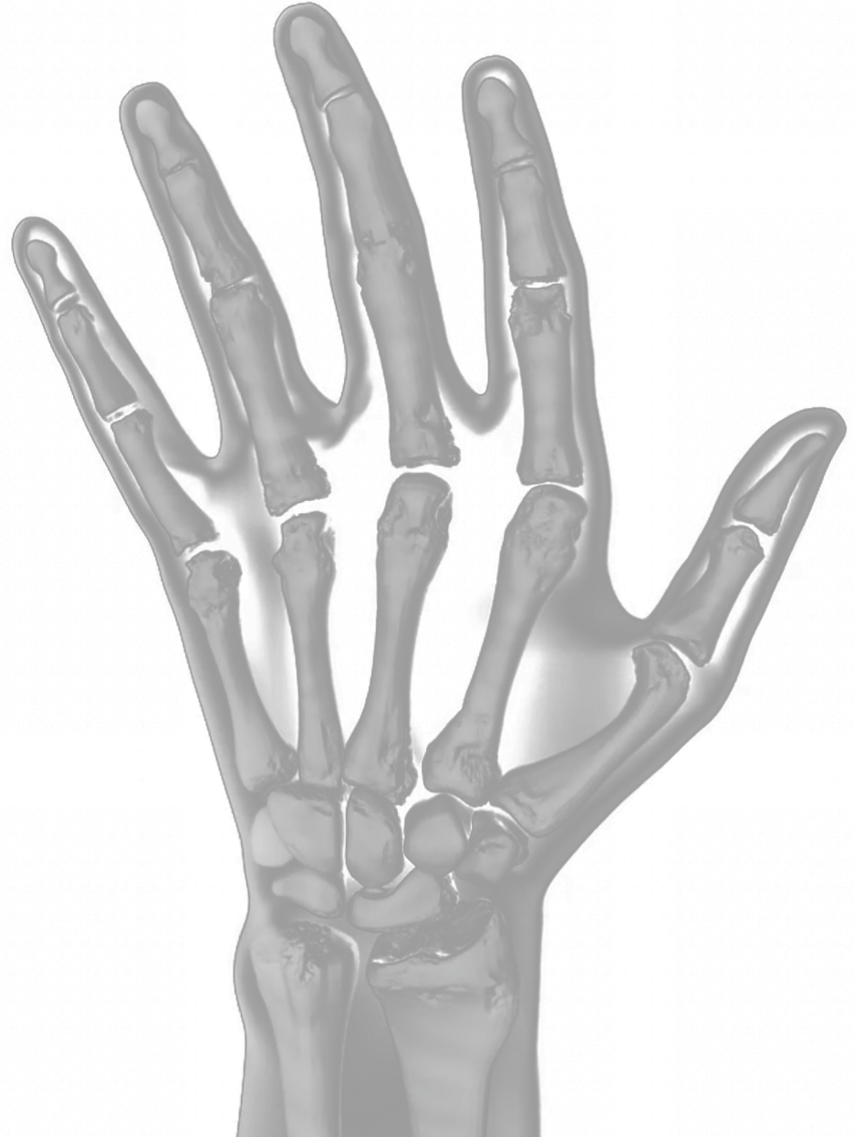 X-ray of a hand showing advanced RA joint damage